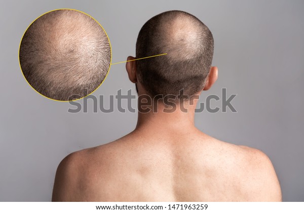 The concept of male alopecia and hair loss. Rear\
view of the man\'s head with a bald spot. Bare shoulders. Enlarged\
picture of the problem area