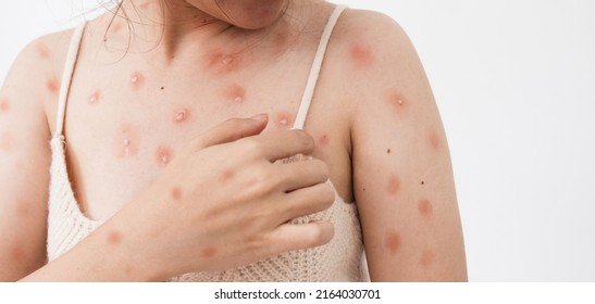Concept of monkeypox epidemic, white woman Skin erythema, pustules, and boils, itching after being infected with the monkeypox virus.
