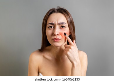 The Concept Of Rosacea. A Caucasian Brunette Woman Points A Finger At A Red Cheek With Inflammation. Copy Space. Gray Background