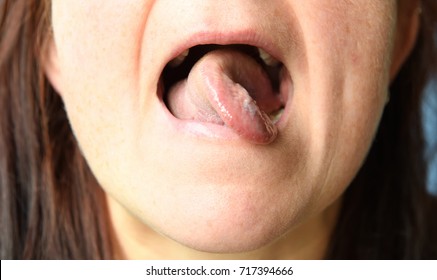 Concept Of Tongue Tied, Woman With Twisted Tongue.