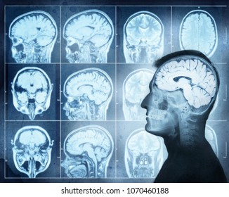 Conceptual Image Of A Man From Side Profile Showing Brain  Activity. Magnetic Resonance Image (MRI) Of The Brain