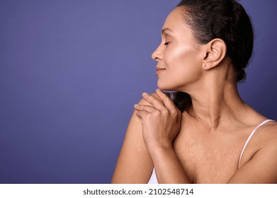 Confident Closeup Portrait. Delightful Natural Beauty Woman With Vitiligo Dermatological Skin Problems Smiling, Hugging Herself Against Violet Background. Body Positivity, Self-acceptance. Copy Space