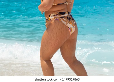 Confident Woman Is Seen On A Sunny Beach In A Colorful Swimsuit, Heavy Dimples And Indentations Are Seen In The Skin Around The Upper Legs, Symptomatic Of Cellulite, A Common Complaint In Mature Wom