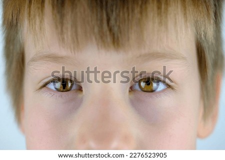 congenital colaboma of child iris, pear-shaped black spot, chromosomal abnormalities, random genetic mutation, ophthalmic disease in which defect in tissues membranes eye occurs in form cleft