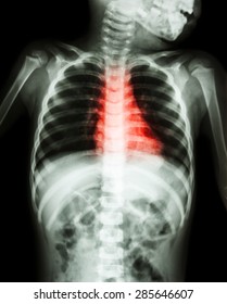 Congenital Heart Disease , Rheumatic Heart Disease ( X-ray Body Of Child And Red Color On Heart Area )