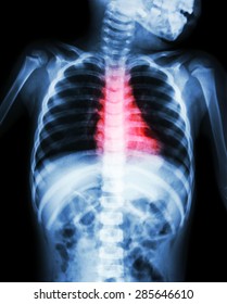 Congenital Heart Disease , Rheumatic Heart Disease ( X-ray Body Of Child And Red Color On Heart Area )