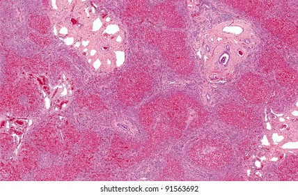 Congenital hepatic fibrosis of the liver showing bands of blue fibrous (scar) tissue connecting multiple liver lobules with marked fibrosis and dilation of bile ducts.
