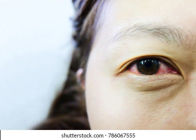 Conjunctivitis Causes Of Inflammation Of The Conjunctiva From Viral.virus In The Dirty Water Splashed Into The Eyes. Especially In The Children.Red Eye, Tears, Eye Pain, Eye Irritation, Eye Irritation