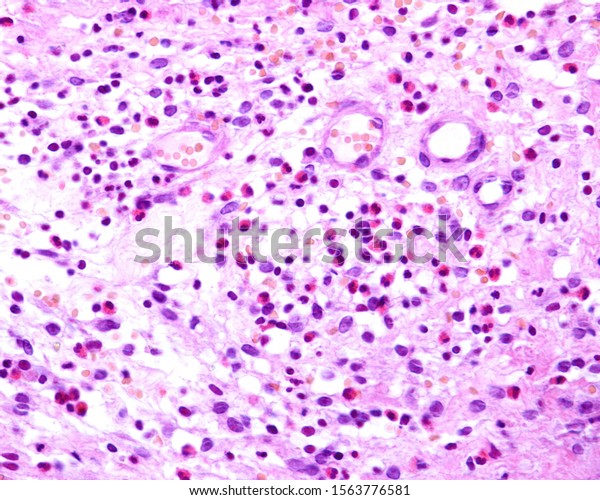 Connective tissue affected by an acute\
inflammation. There is a great predominance of eosinophils among\
the extravasated\
leukocytes.