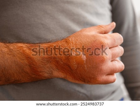 Construction worker showing a large second degree burn with blisters on his arm