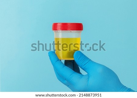 Container with urine sample for laboratory analysis on urinary infection