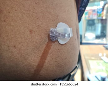 Continuous Glucose Monitoring Pod. Technology For Glucose Check Wireless 