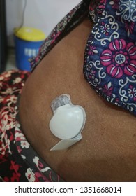 Continuous Glucose Monitoring Pod. Technology For Glucose Check Wireless 