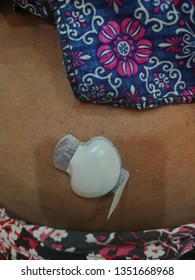 Continuous Glucose Monitoring Pod. Technology For Glucose Check Wireless 