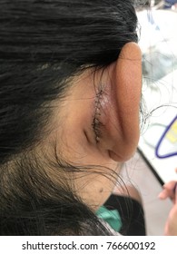 Continuous stitching Behind the ear