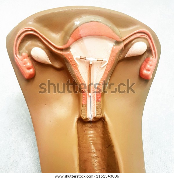 Sex iud during 8 Reasons