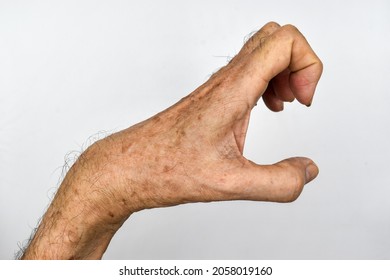 Volkmann’s Contracture In Left Upper Limb Of Southeast Asian Elder Man. It Is A Permanent Shortening Of Forearm Muscles That Gives Rise To A Clawlike Posture Of The Hand, Fingers, And Wrist.