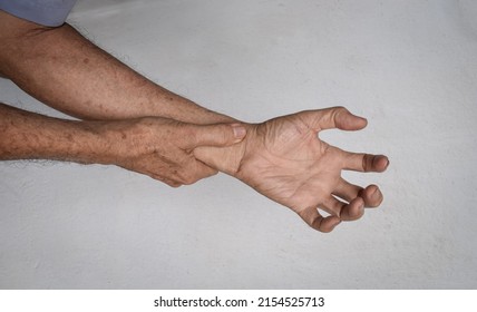 Volkmann’s Contracture In Left Upper Limb Of Southeast Asian Elder Man. It Is A Permanent Shortening Of Forearm Muscles That Gives Rise To A Clawlike Posture Of The Hand, Fingers, And Wrist.