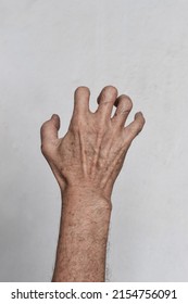 Volkmann’s Contracture In Left Upper Limb Of Southeast Asian Elder Man. It Is A Permanent Shortening Of Forearm Muscles That Gives Rise To A Clawlike Posture Of The Hand, Fingers, And Wrist.