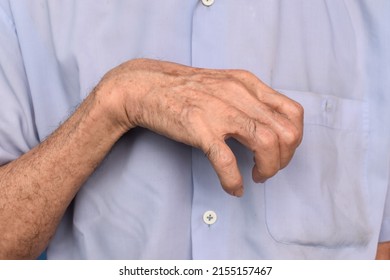 Volkmann’s Contracture In Left Upper Limb Of Southeast Asian Elder Man. It Is A Permanent Shortening Of Forearm Muscles That Gives Rise To A Clawlike Posture Of The Hand, Fingers, And Wrist.