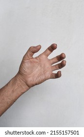 Volkmann’s Contracture In Left Upper Limb Of Southeast Asian Elder Man. It Is A Permanent Shortening Of Forearm Muscles That Gives Rise To A Clawlike Posture Of The Hand, Fingers, And Wrist.