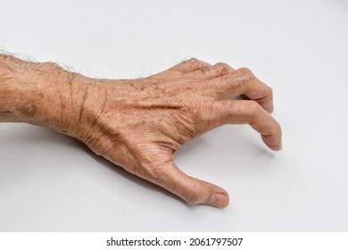 Volkmann’s Contracture In Upper Limb Of Asian Old Man. It Is A Permanent Shortening Of Forearm Muscles That Gives Rise To A Clawlike Posture Of The Hand, Fingers, And Wrist.