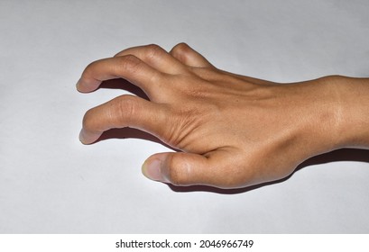 Volkmann’s Contracture In Upper Limb Of Asian Young Woman. It Is A Permanent Shortening Of Forearm Muscles That Gives Rise To A Clawlike Posture Of The Hand, Fingers, And Wrist.