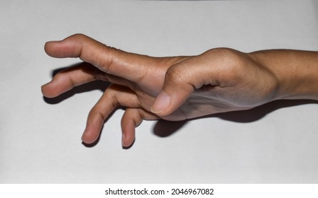 Volkmann’s Contracture In Upper Limb Of Asian Young Woman. It Is A Permanent Shortening Of Forearm Muscles That Gives Rise To A Clawlike Posture Of The Hand, Fingers, And Wrist.