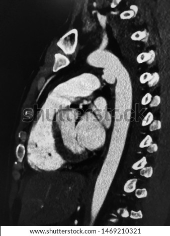 Contrast enhanced computed tomography of aorta (Aortic CTA), one of CT scan imaging technique, showing aneurysm at junction of aortic arch and descending thoracic aorta