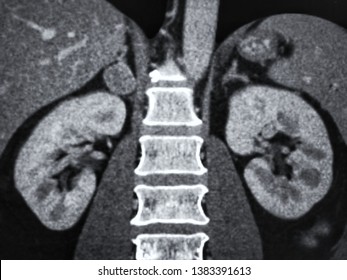 Contrast enhanced CT scan (computed tomography scan)  showing normal both kidneys and right adrenal tumor, medical imaging