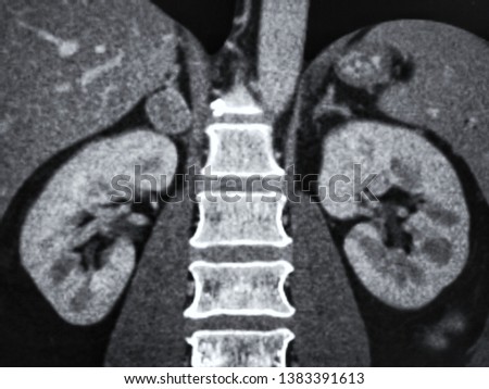 Contrast enhanced CT scan (computed tomography scan)  showing normal both kidneys and right adrenal tumor, medical imaging