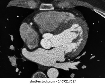 Contrast Enhanced CT Scan Of The Heart (Cardiac CT), Medical Imaging