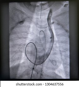 Contrast Media Injection Under Fluoroscope Was Performed Left Subclavian Vein (LSVC).