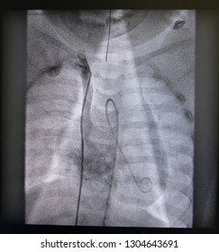 Contrast Media Injection Under Fluoroscope Was Performed Right Subclavian Vein (RSVC).