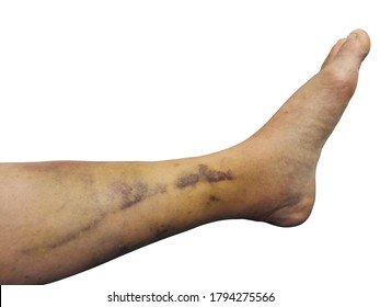 Contusion Images, Stock Photos & Vectors | Shutterstock