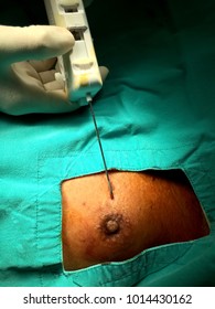 Core Needle Biopsy Of Male Breast Mass For Diagnosis Cancer
