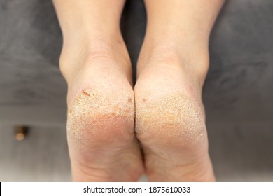 Corn callus cracks on sole heel foot close up. Dry skin dermatology problem. bloody cracks, common skin disease in dry winter, dehydrated skin on the heels of male feet with calluses