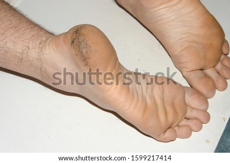 Corn callus cracks on a sole heel foot close up. Dry skin dermatology problem.