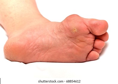 Corns On Foot Images, Stock Photos & Vectors | Shutterstock