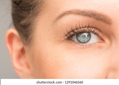 Corneal Opacity Of Woman Eye