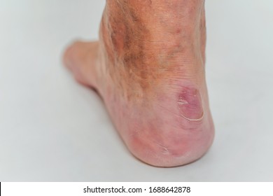 foot fungus on heel