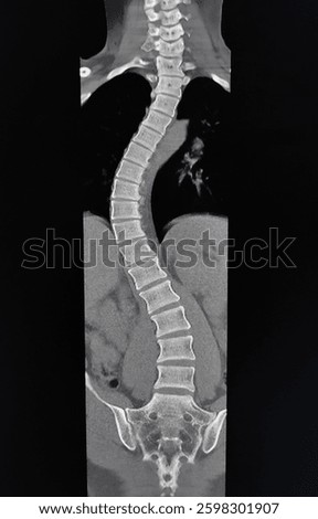 Coronal CT Scan Image of Spine with Scoliosis Abnormality