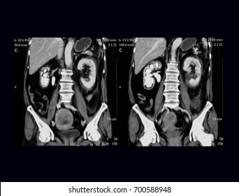 Coronal CT Scan Of Whole Abdomen, Showing Parenchymal Defect At Middle Pole Of Left Kidney And Staghorn Right Renal Stones With Mild Right Hydronephrosis 