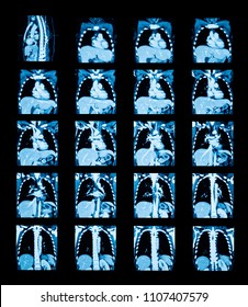 Coronal View Of Computed Tomography Scan Of Pulmonary Veins (CTV) With Intravenous Contrast Administration, Case Of Superior Venacava Obstruction (SVC Obstruction), A 38 Year Old Female Patient