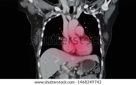 A coronal view of computer tomography or CT scan of heart and chest wall showing normal heart, lungs, artery and vessel. No myocardial infarction or pneumonia sign.