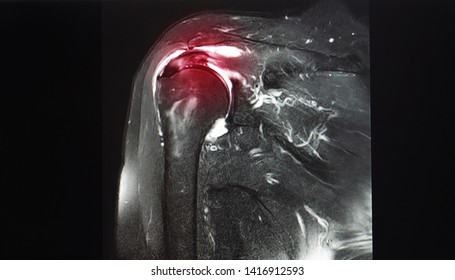 A Coronal View Magnetic Resonance Image Or MRI Of Shoulder Showing Partial Tear Of Supraspinatus Tendon. The Tendon Is A Part Of Rotator Cuff Tendon. Patient May Needed Arthroscopic Surgery.