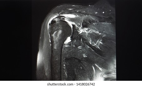 A Coronal View Magnetic Resonance Image Or MRI Of Shoulder Showing Partial Tear Of Supraspinatus Tendon. The Tendon Is A Part Of Rotator Cuff. Patient May Needed Arthroscopic Surgery.