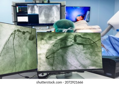 Coronary angiogram (CAG)  on LCD monitor  and Blurred of modern Cath Lab with the doctor, nurse, and patient in the operating room background
