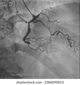 Coronary angiogram (CAG) was performed chronic total occlusion (CTO) at right coronary artery (RCA).
