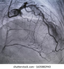 Coronary Angiogram (CAG) Was Performed Left Anterior Descending Artery (LAD) Stenosis With Collateral To Right Coronary Artery (RCA).